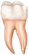 Vertical Root Fracture