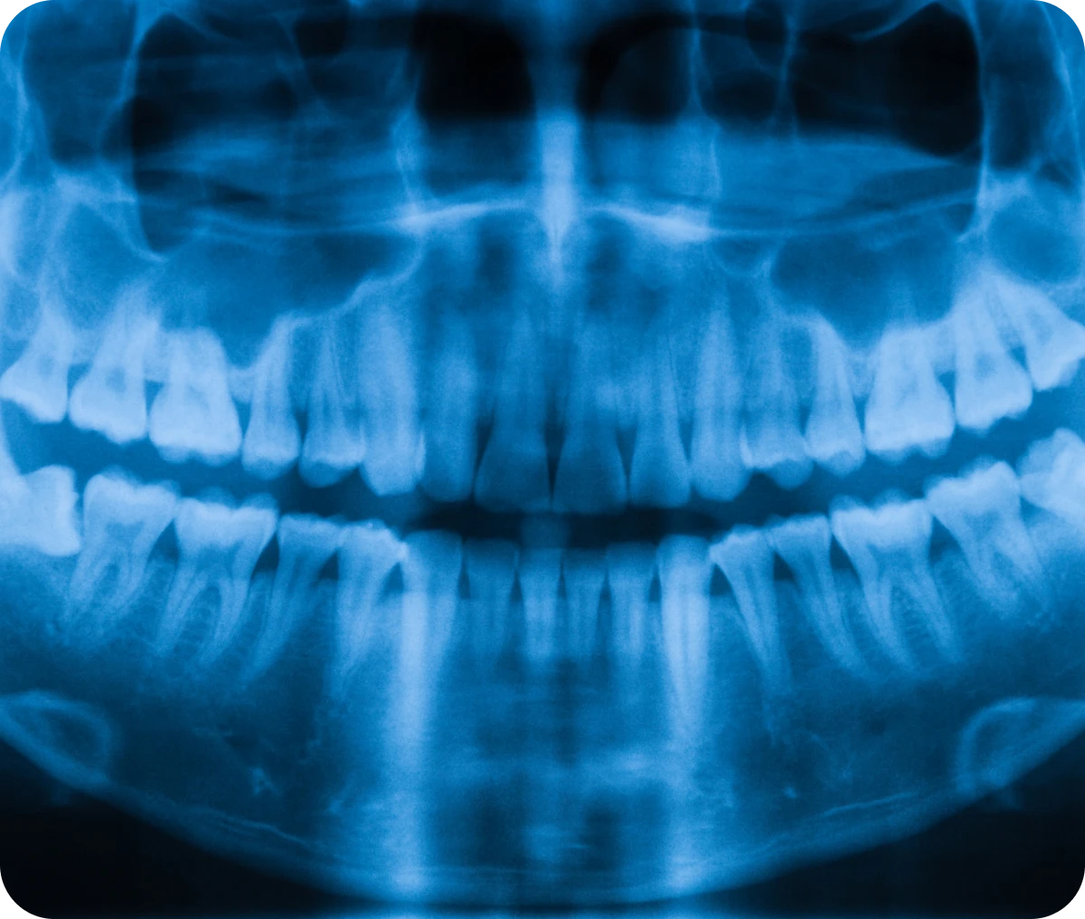 Blue tinted dental panoramic X-ray