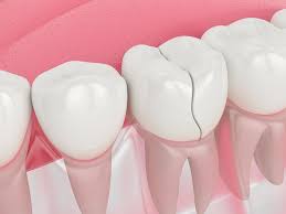 Split Tooth