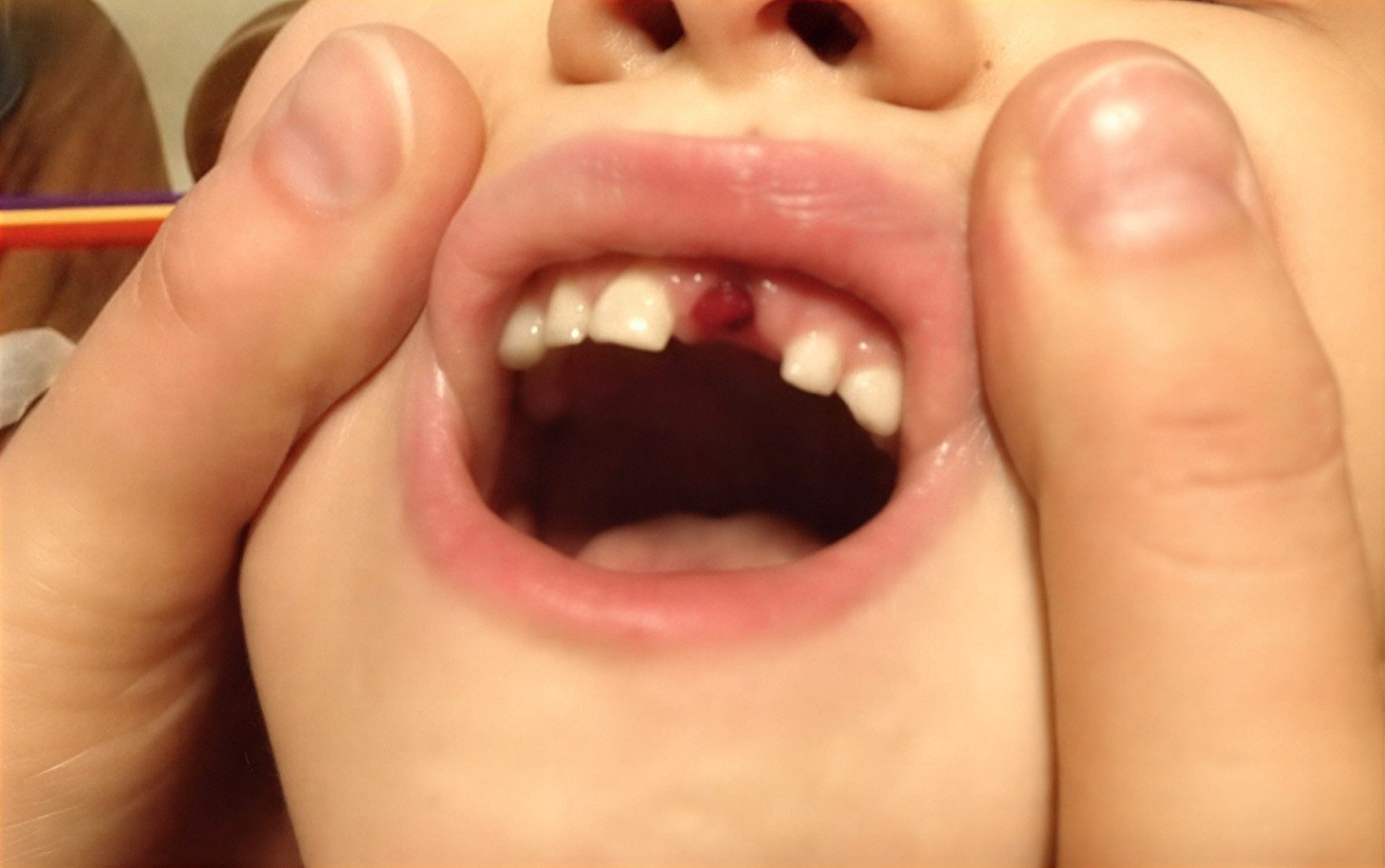 teeth-avulsion_1530635907 (1)